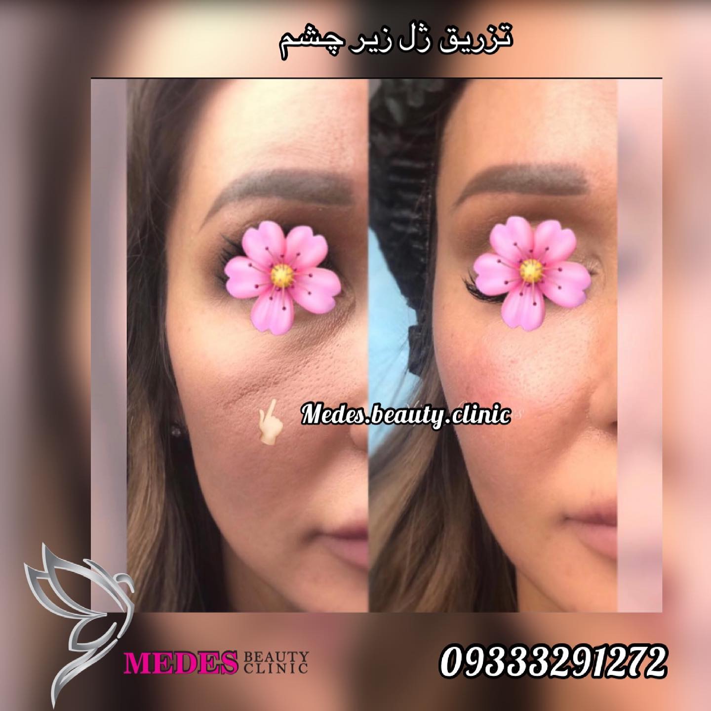 گالری فیلر زیر چشم